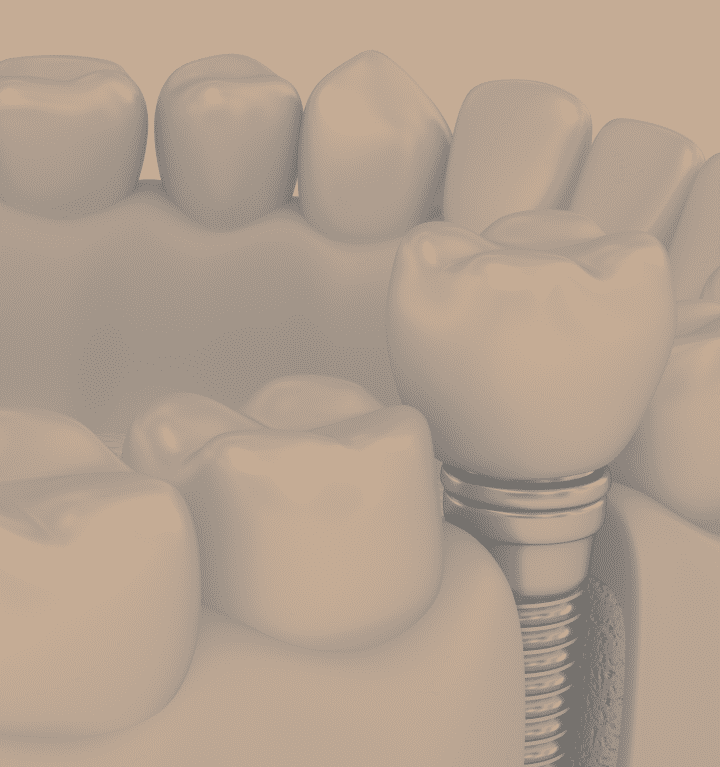 Implants and immediate teeth