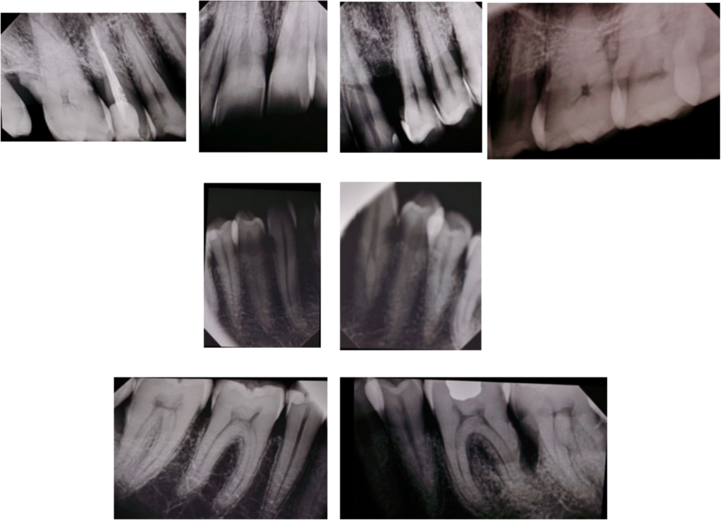 Periapical X rays