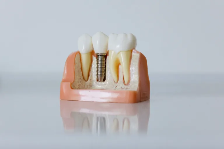 como limpiar implantes dentales fijos