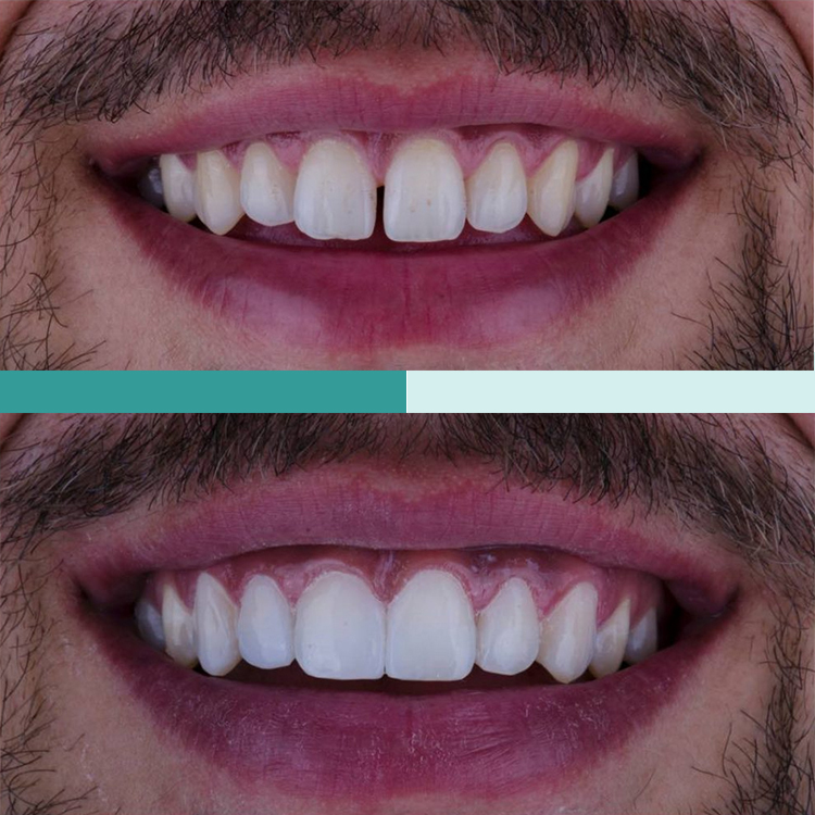 Facettes dentaires en composite