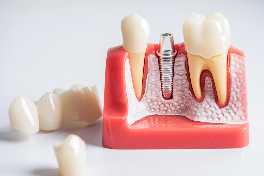 dientes perdidos implantes