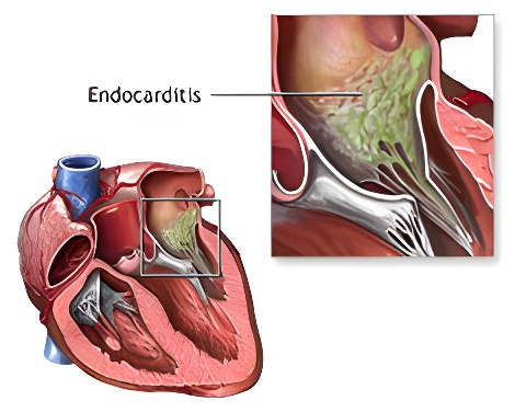Endocarditis bacteriana
