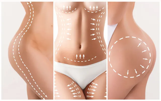 lipoescultura