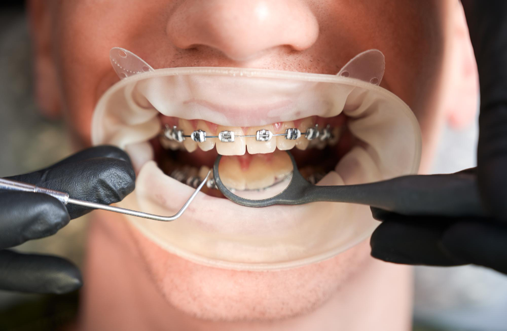 dientes separados