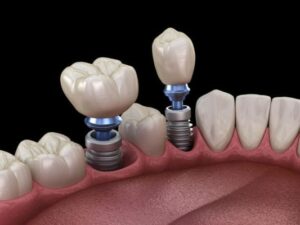 Implantes dentales en un solo día